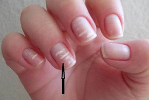 Что означают белые полоски на ногтях: причины появления и способы лечения
