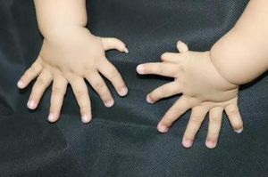 В китайской провинции родился малыш с 31 пальцем на руках и ногах