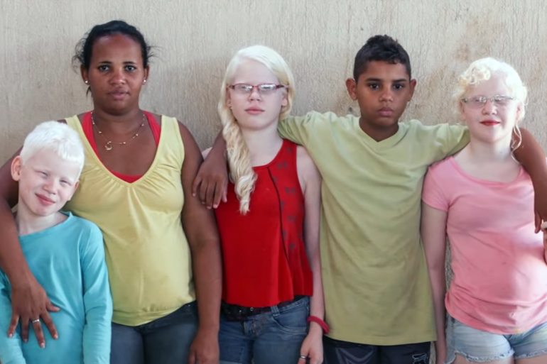 У темноволосых родителей родился светловолосый ребенок. Семья альбиносов. Люди с разным цветом кожи. Альбинос и обычный человек. Дети альбиносов и обычных людей.
