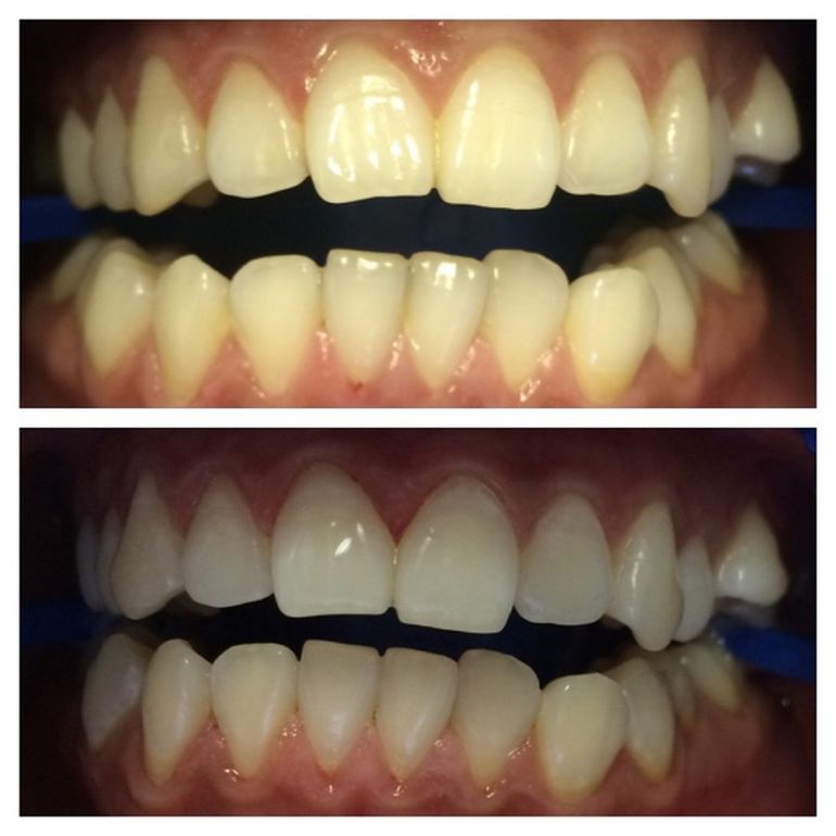 реставрация зуба после отбеливания