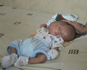 Двуликий мальчик из Индонезии прожил уже 2 месяца