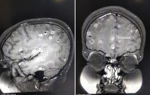 В мозгу 8-летней девочки обнаружили более 100 личинок глиста солитера