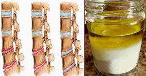Мощная природная смесь быстро укрепит кости и устранит боли в коленях, спине и суставах!