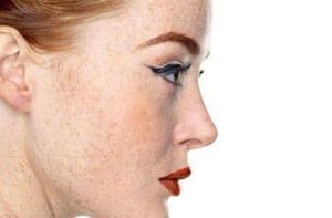 Пигментные пятна на лице: причины появления и методы устранения с кожи лица