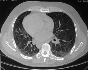 Компьютерная томография грудной клетки
