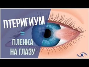 Избавиться от плёнки в глазах (птеригиума) быстро и без хирургии, вам поможет этот рецепт!