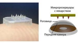 Новое слово в лечении глазных болезней — колючие контактные линзы