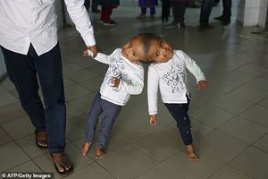 Сросшиеся головами близнецы прилетели из Бангладеш в Венгрию на операцию