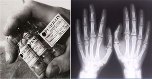 Рентген и пенициллин: 6 случайных изобретений, которые изменили мир