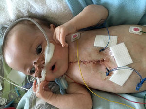 Чудо-ребенок пережил 25 сердечных приступов за день и выжил