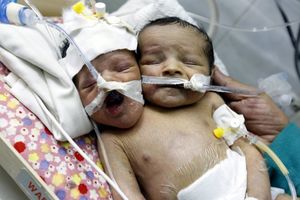 В Йемене родился двухголовый ребенок