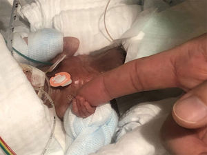 Самого маленького недоношенного ребенка в мире выписали из больницы