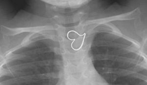 Трехлетняя девочка проглотила кулон, и удивила врачей «идеальным» рентгеном                     (3 фото)