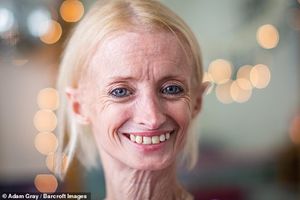 41-летняя женщина является самой старой больной прогерией в мире