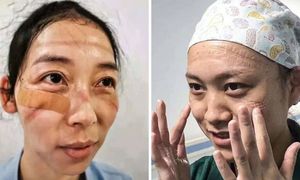 Китайские медсестры делятся фотографиями своих лиц со следами медицинских масок