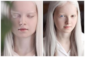 Девочка-альбинос из Чечни поразила своей уникальной внешностью