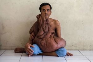 Индонезиец с 38-килограммовой опухолью на лице мечтает об операции