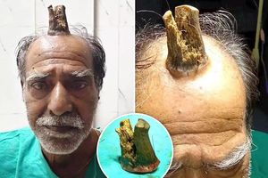Человек-единорог: 74-летнему индийцу удалили жуткий нарост на голове