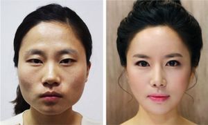 «Вишневые губы», уменьшение челюсти, пластика ноздрей: какие операции популярны в Южной Корее