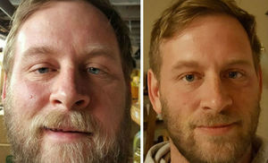 До и после: как меняется внешность человека, который перестает пить