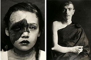 Портреты боли: поразительные фотографии пациентов из XIX века, страдающих от тяжких болезней
