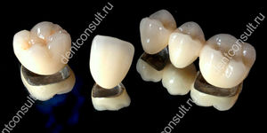 Сколько стоят зубы из металлокерамики