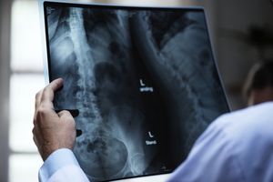 Эндокринологический научный центр рассказал, как лечить остеопороз и избежать переломов