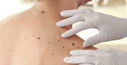 Компания BioNTech предложила новый метод лечения рака кожи