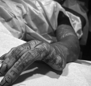Чтобы стать «черным инопланетянином», мужчина, одержимый бодиартом, отрезал себе пальцы