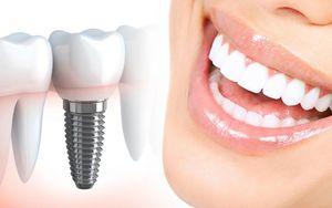 Особенности технологии имплантации зубов, а также наличие противопоказаний
