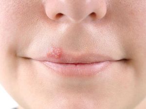 Раздражение и покраснение вокруг рта — возможные причины и особенности лечения