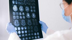 Инсульт, миелит и делирий: вирусолог рассказал, как нейроковид влияет на мозг