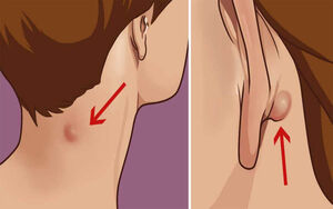 Что нужно знать, если у вас есть такое уплотнение на шее или за ухом...