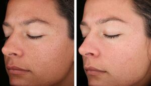 Что такое транексамовая кислота и какие проблемы с кожей она решает?