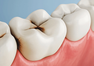 Почему на самом деле появляется кариес — и при чём здесь сахар