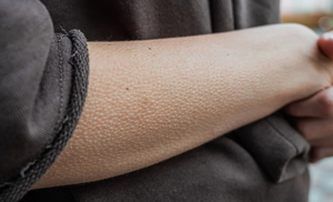 Почему появляются «мурашки» на коже и как от них избавиться