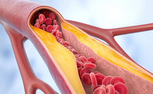 Атеросклероз: «тихий враг», о котором важно знать каждой женщине