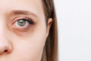 Мешки и тёмные круги под глазами: почему они появляются и как с ними бороться
