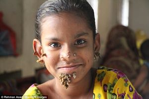 Первая в мире «девочка-дерево» появилась в Бангладеш