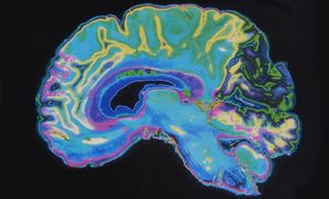 Искусственный интеллект научился выявлять ранние симптомы шизофрении