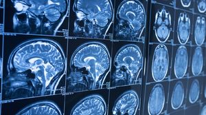 ИИ способен выявить болезнь Альцгеймера за годы до появления симптомов
