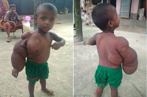 У двухлетнего малыша из Бангладеш одна рука уже почти размером с туловище