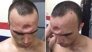 Тайский боксер получил необычную, но очень показательную травму