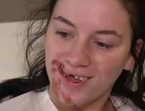 18-летняя девушка лишилась зубов, спасая своего щенка от угонщиков автомобиля