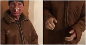 Житель Казахстана страшно обморозил лицо и руки