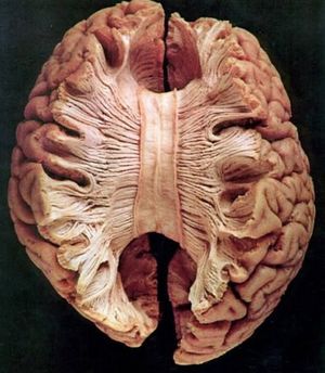 Мозолистое тело: загадка женской интуиции открыта?