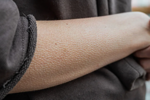 Почему появляются «мурашки» на коже и как от них избавиться