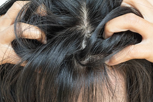 Почему чешется голова: 5 самых частых причин