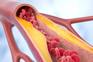 Атеросклероз: «тихий враг», о котором важно знать каждой женщине